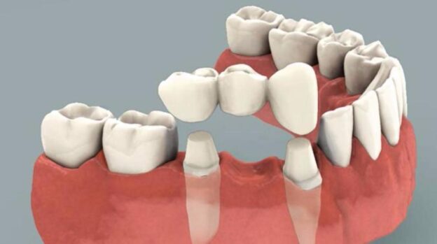 dental crown cost