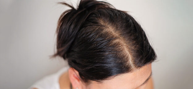 Ultimate Guide to Treating Hair Loss: Proven Methods and Solutions