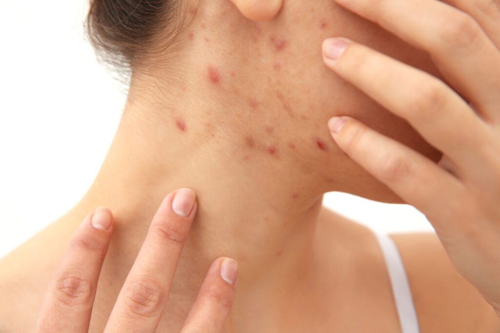 Therapeutic Dermatology